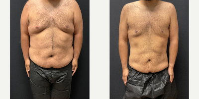 25-34 year old man treated with Semaglutide - 100lbs lost on Semaglutide