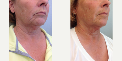 55-64 year old woman treated with Pelleve - Woman treated with Pelleve