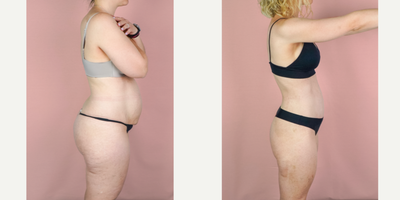 35-44 year old woman treated with Mommy Makeover, Tummy Tuck, Breast Augmentation, Liposuction, Breast Implants - This lovely patient is shown 3 months post-op from mommy makeover consisting of a breast augmentation, abdominoplasty and liposuction. She came to me after hitting a plateau along her journey to a slimmer physique. Oftentimes, diet and exercise are not enough and surgery is needed to tighten muscles and remove excess skin. Her implants were smooth, round silicone and they were placed in a dual-plane to allow a small amount of lift. Here, you can see a huge transformation. Her results are exceptional because she adopted a healthy lifestyle after surgery to continue to improve upon her results.