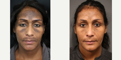 Regenerative Medicine for Pigmentation - PRP and microneedling for facial pigmentation.