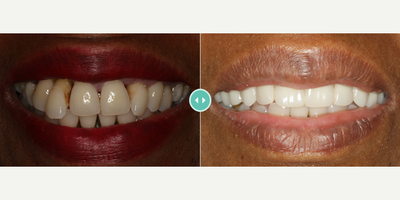 Man treated with Dental Implants - Man treated with Dental Implants