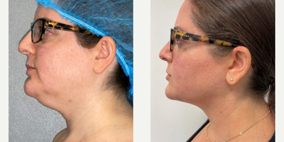 Woman treated with Chin Liposuction - Woman treated with Chin Liposuction