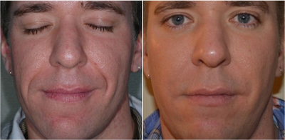 25-34 year old man treated with Cheek Lift - Before and after filler injections for facial rejuvenation and contouring (liquid face lift)