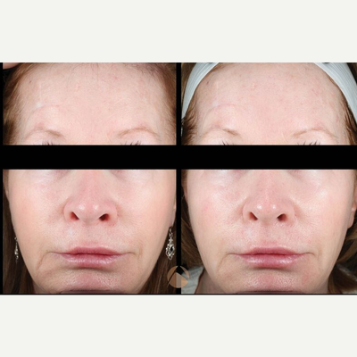 Woman treated with Pelleve - Woman treated with Pelleve