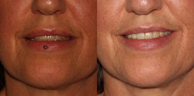 55-64 year old woman treated with Excel V - Female, treated 1x with Excel V 1064 Laser for Venous Lake on lip.