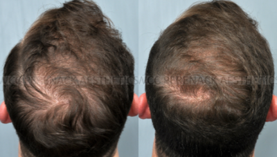 18-24 year old man treated with Hair Loss Treatment - This patient was treated using PRP Hair Restoration. PRP is a revolutionary step in utilizing your own body's plasma to promote natural rejuvenation and cellular growth. This patient's pictures are taken after 2 rounds of PRP treatment the morning of his 3rd round.