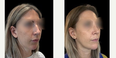 25-34 year old woman treated with Chin Implant, Rhinoplasty - A rhinoplasty performed using a closed scarless preservation rhinoplasty technique combined with a chin implant
