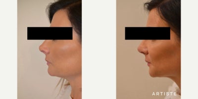 42 year old woman treated with Rhinoplasty - 42 year old woman treated with Rhinoplasty.