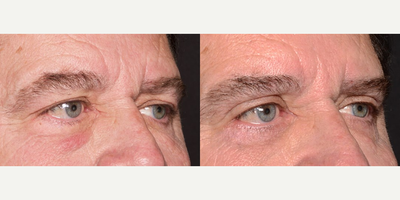 Man in his 60s treated with Double Eyelid Surgery - Man in his 60s treated with Double Eyelid Surgery