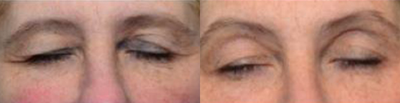 Woman treated with ThermiSmooth - ThermiSmooth