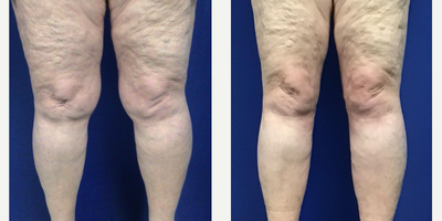 71 year old patient - Tickle Lipo to de-bulk knees - 71 year old patient had in-office liposuction to de-bulk her knees. She will eventually undergo some skin tightening procedures on her thighs, but is thrilled with how her knees look now in shorts and dresses.