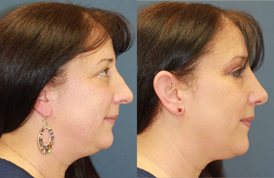 Rhinoplasty - Cosmetic & Functional Rhinoplasty, Open Technique