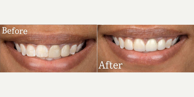 Woman treated with Lumineers - Woman treated with Lumineers.