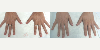 55-64 year old woman treated with Hand Rejuvenation, Radiesse, Juvederm - Hand rejuvenation with dermal filler injection (Radiesse, Juvederm) using micro-cannula technique