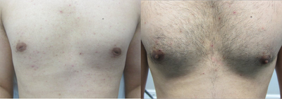 Male having Inverted Nipple Correction - This gentleman had inverted nipple correction under local anaesthetic on the same day as consultation.It takes around 45 minutes in our minor operating suite in Edgbaston and you go home with a waterproof dressing so can wash and shower straight away.