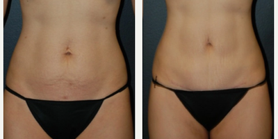 Woman treated with Mini Tummy Tuck - Woman treated with Mini Tummy Tuck- 4 months post-op