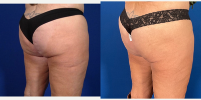 Cellulite Reduction - Cellulite Reduction 2-months following Cellfina and 16 treatments of Acoustic Wave Therapy