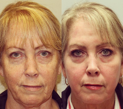 Woman treated with Skin Rejuvenation - Woman treated with Skin Rejuvenation through laser resurfacing using sciton erbium laser to even out the skin tone and smooth the fine lines as well as FaceTite to improve contour of the neck and jowls. Patient felt her face was looking tired and didnt reflect her inner self.