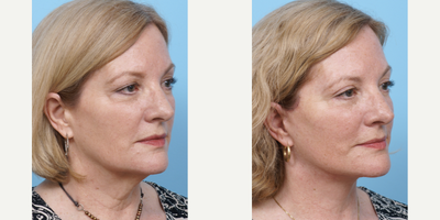 45-54 year old woman treated with Facelift - This patient was concerned with the heaviness of her neck skin and beginnings of jowl formation. She had a facelift, upper eyelid lift and lower eyelid pinch. Note the sharper neckline and jawline and the tightening of lower neck skin.