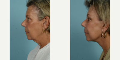 65-74 year old woman treated with Facelift, SMAS Facelift, Neck Lift, Eyelid Surgery, Brow Lift, Facial Fat Transfer, Laser Resu - At the vibrant age of 71, this patient elected to undergo several procedures with Dr. Thomas Mustoe to preserve her natural beauty and active lifestyle without an overly tight or pulled appearance. Her personalized facial rejuvenation included a deep plane facelift/minilift, neck lift, upper blepharoplasty, brow lift, and fat grafting around the mouth, all performed by the skilled hands of Dr. Mustoe in Chicago. Post-procedure results, observable just one month post-op, reflect her desire for a subtle but impactful alteration, enhancing her already attractive features while maintaining her characteristic expressions.The above patient sought to leverage Dr. Mustoe's proficiency not only in facelift/minilift techniques but also in neck lift, blepharoplasty, brow lift, and fat grafting procedures. In addition to these, laser treatment and dermabrasion were used to augment the smoothness and youthfulness of her skin near the mouth area. The successful outcome demonstrates Dr. Mustoe's commitment to meeting the patient's unique requirements. Despite her age, the patient continues to lead a vibrant life post-procedure, which highlights minimal impact on her active lifestyle due to Dr. Mustoe's careful and thoughtful approach.Known for his personalized approach and optimal results, Dr. Thomas Mustoe is an American board-certified plastic surgeon and a respected authority in the field. Renowned for conducting over 10,000 operations, Dr. Mustoe's practice, TLKM Plastic Surgery, located at 737 North Michigan Ave., Chicago, offers innovative and age-defying techniques, including the facelift/minilift procedure. The patient's experience showcases Dr. Mustoe's ability to balance surgical control and aesthetic sensitivity to deliver naturally beautiful results that satisfy the patient's desires while preserving their unique identity.