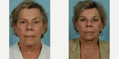 65-74 year old woman treated with Facelift, SMAS Facelift, Neck Lift, Eyelid Surgery, Brow Lift, Facial Fat Transfer, Laser Resu - At the vibrant age of 71, this patient elected to undergo several procedures with Dr. Thomas Mustoe to preserve her natural beauty and active lifestyle without an overly tight or pulled appearance. Her personalized facial rejuvenation included a deep plane facelift/minilift, neck lift, upper blepharoplasty, brow lift, and fat grafting around the mouth, all performed by the skilled hands of Dr. Mustoe in Chicago. Post-procedure results, observable just one month post-op, reflect her desire for a subtle but impactful alteration, enhancing her already attractive features while maintaining her characteristic expressions.The above patient sought to leverage Dr. Mustoe's proficiency not only in facelift/minilift techniques but also in neck lift, blepharoplasty, brow lift, and fat grafting procedures. In addition to these, laser treatment and dermabrasion were used to augment the smoothness and youthfulness of her skin near the mouth area. The successful outcome demonstrates Dr. Mustoe's commitment to meeting the patient's unique requirements. Despite her age, the patient continues to lead a vibrant life post-procedure, which highlights minimal impact on her active lifestyle due to Dr. Mustoe's careful and thoughtful approach.Known for his personalized approach and optimal results, Dr. Thomas Mustoe is an American board-certified plastic surgeon and a respected authority in the field. Renowned for conducting over 10,000 operations, Dr. Mustoe's practice, TLKM Plastic Surgery, located at 737 North Michigan Ave., Chicago, offers innovative and age-defying techniques, including the facelift/minilift procedure. The patient's experience showcases Dr. Mustoe's ability to balance surgical control and aesthetic sensitivity to deliver naturally beautiful results that satisfy the patient's desires while preserving their unique identity.