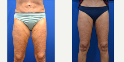 65-74 year old woman treated with BodyTite - liposuction with bodytite and morpheus to the inner thigh