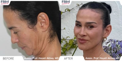 45-54 year old woman treated with Facelift, Deep Plane Facelift, Neck Lift, Lip Lift, Forehead Reduction, Eyelid Surgery, Facial - 45-54 year old woman treated with Facelift, Deep Plane Facelift, Facial Fat Transfer, Forehead Reduction, Eyelid Surgery, Neck Lift, Lip Lift