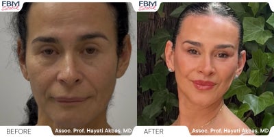 45-54 year old woman treated with Facelift, Deep Plane Facelift, Facial Fat Transfer, Forehead Reduction, Eyelid Surgery, Neck L - 45-54 year old woman treated with Facelift, Deep Plane Facelift, Facial Fat Transfer, Forehead Reduction, Eyelid Surgery, Neck Lift, Lip Lift