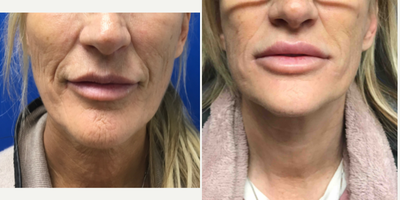 45-54 year old woman treated with Neck Lift - This pretty woman did not like the loose skin on her midline neck. We did a modified neck lift with platysmalplasty and lower face lift.
