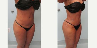 Lipo Only Revision Of Tuck - Pt had a tummy tuck with another physician. She was not happy with the contour. AWAKE lipo was used to reveal her natural curves, 2 day downtime, simple recovery.