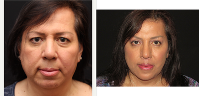 45-54 year old woman treated with MTF Facial Feminization Surgery - Comprehensive facial feminization surgery with hairline advancement, forehead bone contouring, brow lift, facelift, neck lift, lip lift, upper and lower blepharoplasty, chin augmentation.