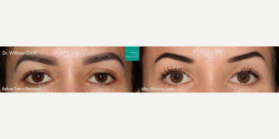 25-34 year old woman treated with Tattoo Removal, PicoWay - PicoWay for eyebrow tattoo removal