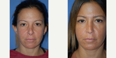 35-44 year old woman treated with Revision Rhinoplasty - Over rotation and open bridge defect improved with revision rhinoplasty.