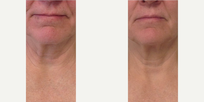 Woman treated with Skintyte - Woman treated with Skintyte.