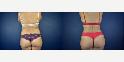 Caribbean Butt Lift, Tummy Tuck, Vaser Liposuction, Butt Augmentation, Hip Augmentation - This is 39 years old female patient was looking for body contour reshaping after her pregnancy. Dr. Valdez performed an extended tummy tuck, full body lipo with Vaser lipo and Microaire and fat transfer to her but and hips area the gave her the Caribbean hourglass body shape.