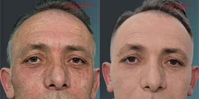 45-54 Years Old Man Treated with PicoSure - Our male patient; whose skin blemishes were eliminated; after Pico Laser treatment.