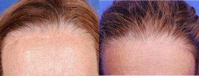 Forehead scar revision - 60 year old woman with forehead scar as the result of browlift from another surgeon.  The patient consulted with Dr. Yoo for options to make the scar less conspicuous. &nbsp;A scar revision was performed with a trichophytic incision allowing the hair to grow through the scar and covering it.  After results are shown 4 months from surgery.&nbsp;