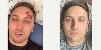 18-24 year old man treated with Scar Removal - Patient treated for scar on forehead