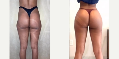 Woman treated with Hip Implants - Woman treated with Hip Implants