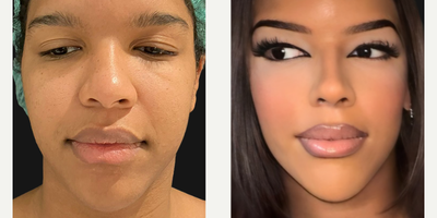 Woman treated with African American Rhinoplasty - Woman treated with African American Rhinoplasty