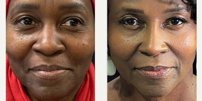 Woman treated with African American Rhinoplasty - Woman treated with African American Rhinoplasty