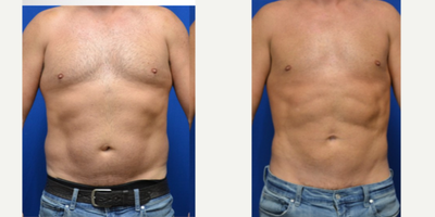 35-44 year old man treated with Liposuction, Abdominal Etching, Umbilical Hernia Repair - Liposuction areas: upper abdomen, lower abdomen, full waist, and chest