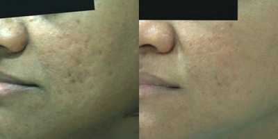 25-34 year old man treated with Derma Roller - Microneedling with platelet rich plasma (PRP) for acne scarring improvement. After 6 treatments improvement in color, texture, and scarring is noted.