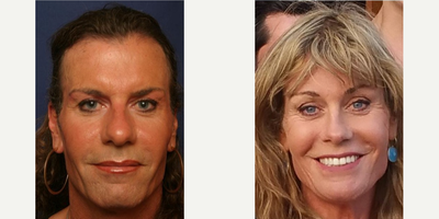 MTF Facial Feminization Surgery - MTF Facial Feminization Surgery