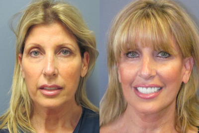 LiteLift - 
	This patient reduced signs of aging around the jaw, neck, and lower face by having the LiteLift&trade;, a type of mini facelift.
