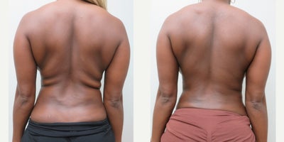 25-34 year old woman treated with Liposuction - This patient underwent liposuction to her upper and lower back.