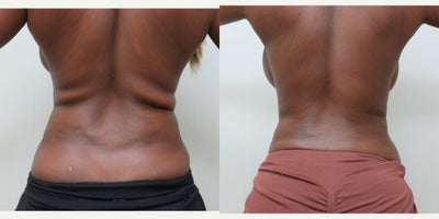25-34 year old woman treated with Liposuction - This patient underwent liposuction to her upper and lower back.