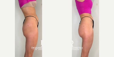 35-44 year old woman treated with Sculptra Butt Lift - Dr. Jarrett Schanzer uses safe and long-lasting dermal fillers and collagen biostimulators like Sculptra and Hyperdilute Radiesse to give you the butt projection youve always wanted.No risky surgery with fat transfer or surgical implants necessary. Our treatments are perfect for anyone looking to enhance their curves and feel more confident in their own skin.