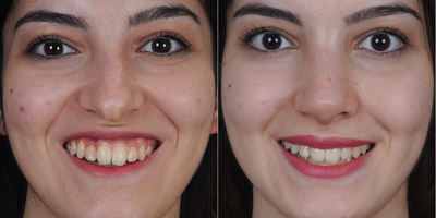 25-34 year old woman treated with Lip Repositioning - Lip Repositioning before and after