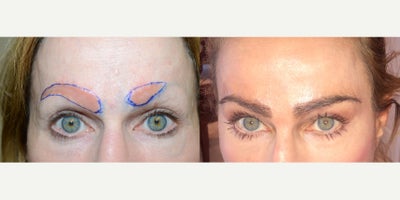 45-54 year old woman treated with Eyebrow Transplant - Extreme case, whereby this patient required excision of the entire eyebrows as a result of severe scarring from attempted laser removal of prior eyebrow tattoo. Three months after removing the entire right eyebrow and most of the left eyebrow, she underwent a hair transplant to restore both eyebrows, the results shown eight months later.